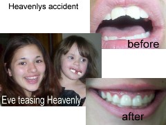 when Hev Chipped her teeth